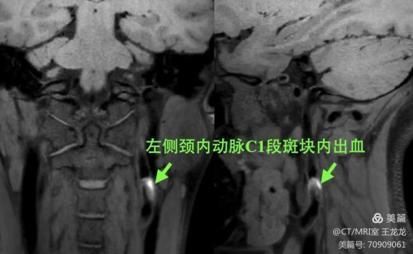 血管壁高分辨成像在头颈部血管斑块的危险性评估应用