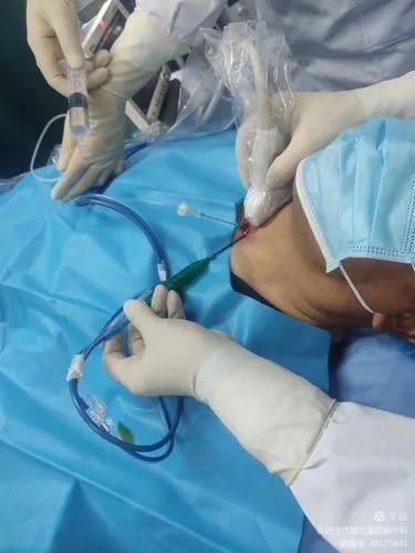 微波消融在甲状腺结节治疗的应用