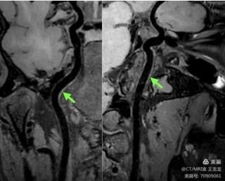 血管壁高分辨成像在头颈部血管斑块的危险性评估应用