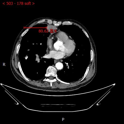 不开刀杀肿瘤：血管介入科开展首例CT引导下肺恶性肿瘤射频消融术