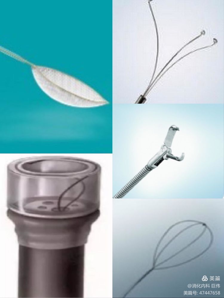 网篮在异物取出术中的应用